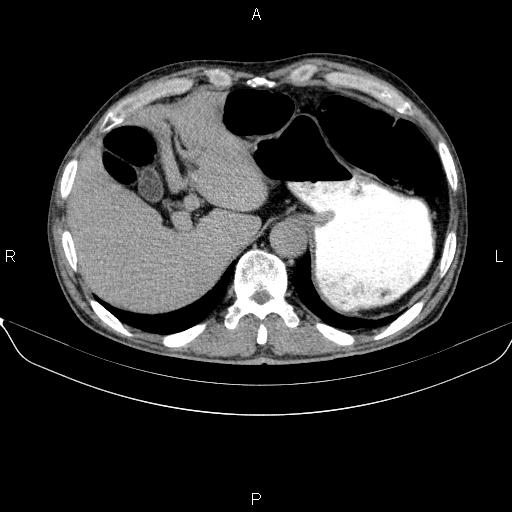 Ampullary adenocarcinoma (Radiopaedia 86093-102032 Axial C+ delayed 18).jpg