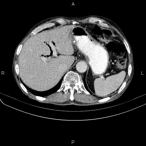 Ampullary adenocarcinoma (Radiopaedia 86093-102033 B 52).jpg