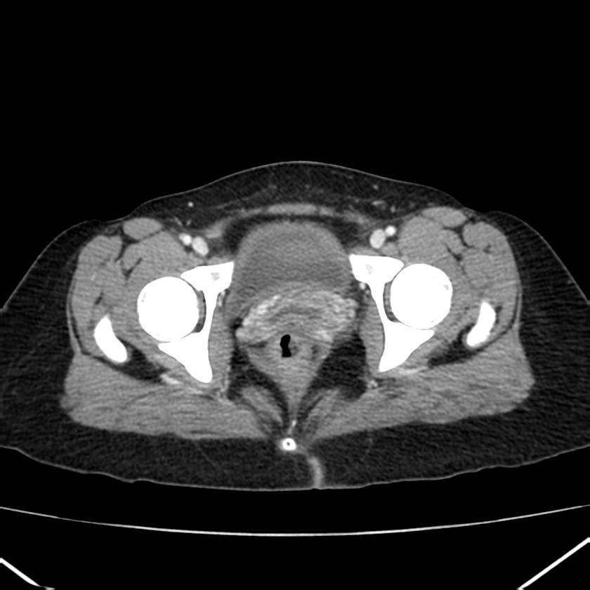 Ampullary tumor (Radiopaedia 22787-22816 C 67).jpg