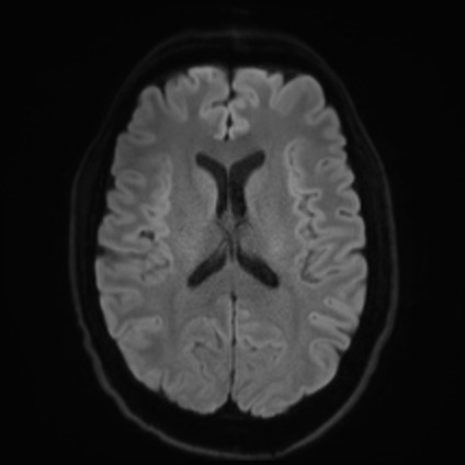 File:Amyotrophic lateral sclerosis (Radiopaedia 87352-103658 Axial DWI 44).jpg