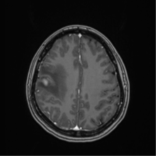 File:Anaplastic astroblastoma (Radiopaedia 55666-62194 Axial T1 C+ 54).png
