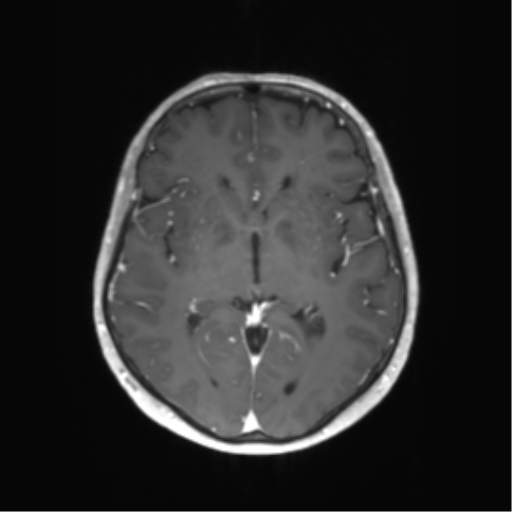 File:Anaplastic astrocytoma (Radiopaedia 86943-103160 Axial T1 C+ 25).png