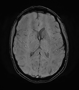 File:Anaplastic astrocytoma IDH mutant (Radiopaedia 50046-55341 Axial SWI 50).png