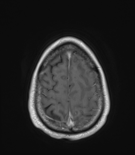 Anaplastic astrocytoma IDH wild-type (Radiopaedia 49984-55273 Axial T1 C+ 49).png