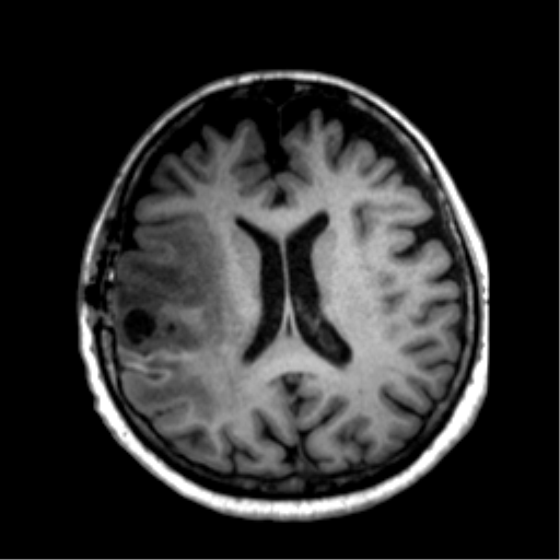 Anaplastic astrocytoma IDH wild-type (pseudoprogression) (Radiopaedia 42209-45277 Axial T1 80).png