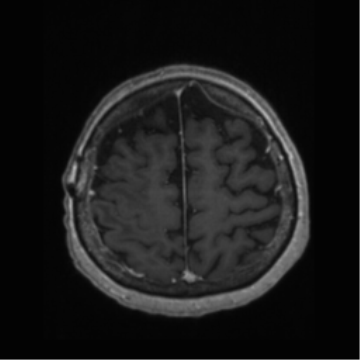 File:Anaplastic astrocytoma IDH wild-type (pseudoprogression) (Radiopaedia 42209-45277 Axial T1 C+ 102).png