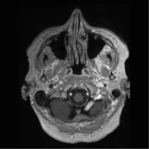 File:Anaplastic astrocytoma IDH wild-type (pseudoprogression) (Radiopaedia 42209-45277 Axial T1 C+ 6).png