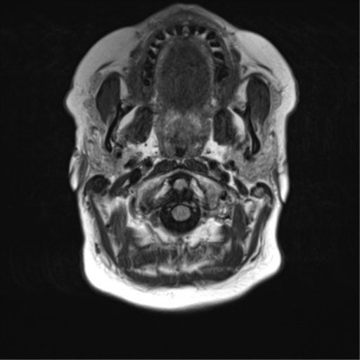 File:Anaplastic oligodendroglioma (Radiopaedia 83500-98599 Axial FLAIR 2).png