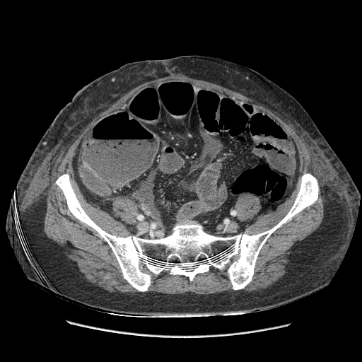 Anastomosis leak at ileostomy closure site (Radiopaedia 82138-96184 B 172).jpg