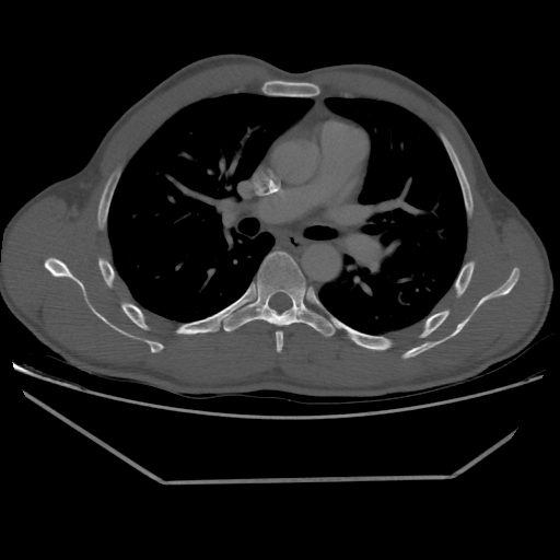Aneurysmal bone cyst - rib (Radiopaedia 82167-96220 Axial bone window 124).jpg