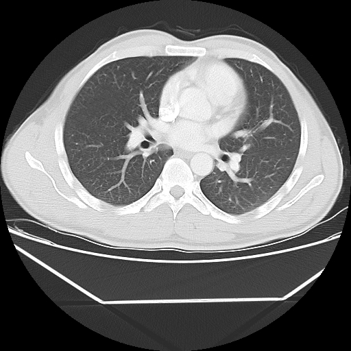 File:Aneurysmal bone cyst - rib (Radiopaedia 82167-96220 Axial lung window 36).jpg