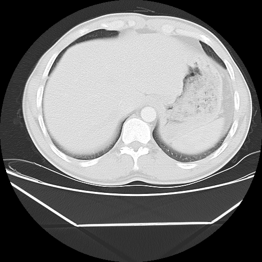 File:Aneurysmal bone cyst - rib (Radiopaedia 82167-96220 Axial lung window 55).jpg