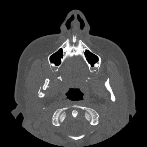 Aneurysmal bone cyst of the mandible (Radiopaedia 43280-46823 Axial bone window 101).jpg