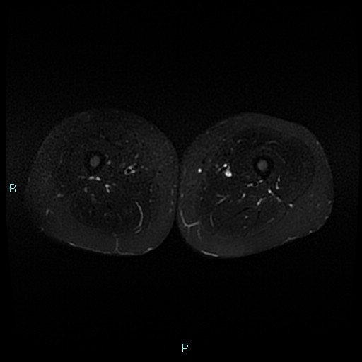 Angioleiomyoma (Radiopaedia 85442-101078 Axial STIR 50).jpg