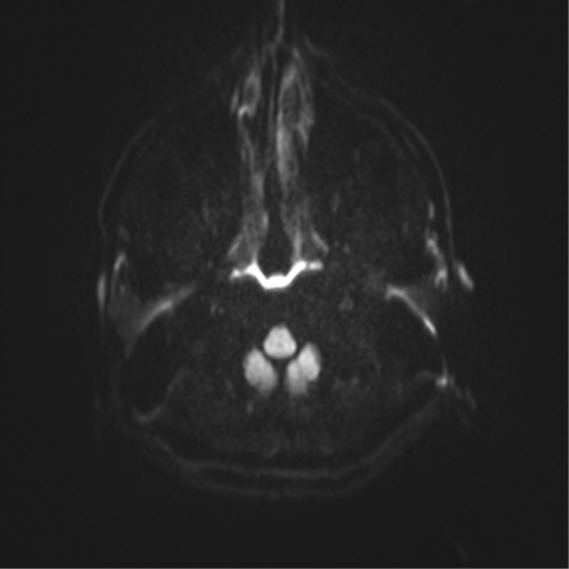 Angular epidermoid cyst (Radiopaedia 46908-51438 Axial DWI 77).png