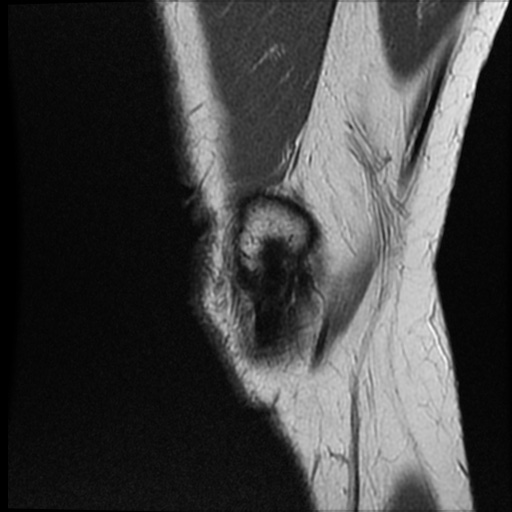 Anomalous insertion of the medial meniscus (Radiopaedia 77559-89721 Sagittal PD 47).jpg