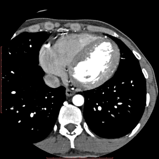 Anomalous left coronary artery from the pulmonary artery (ALCAPA) (Radiopaedia 70148-80181 A 272).jpg