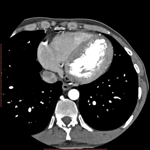 Anomalous left coronary artery from the pulmonary artery (ALCAPA) (Radiopaedia 70148-80181 A 279).jpg