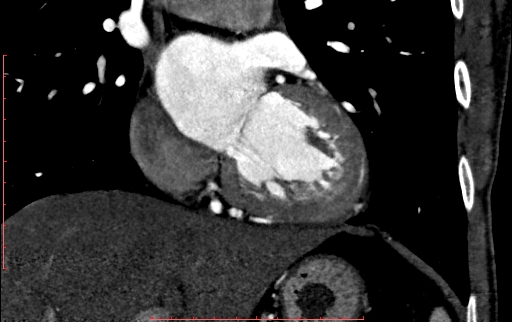 Anomalous left coronary artery from the pulmonary artery (ALCAPA) (Radiopaedia 70148-80181 B 162).jpg