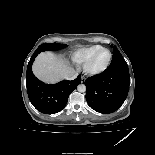 Anorectal carcinoma (Radiopaedia 44413-48064 A 5).jpg