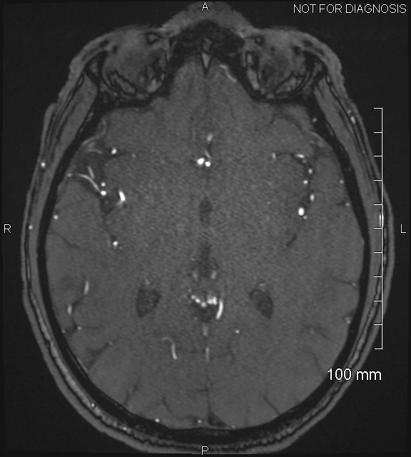 Anterior cerebral artery aneurysm (Radiopaedia 80683-94127 Axial MRA 124).jpg