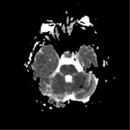 File:Anterior cerebral artery territory infarct (Radiopaedia 39327-41584 Axial ADC 7).png