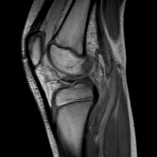 File:Anterior cruciate ligament avulsion fracture (Radiopaedia 24710-24974 Sagittal T1 7).jpg
