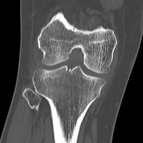 File:Anterior cruciate ligament avulsion fracture (Radiopaedia 58939-66194 Coronal bone window 18).jpg