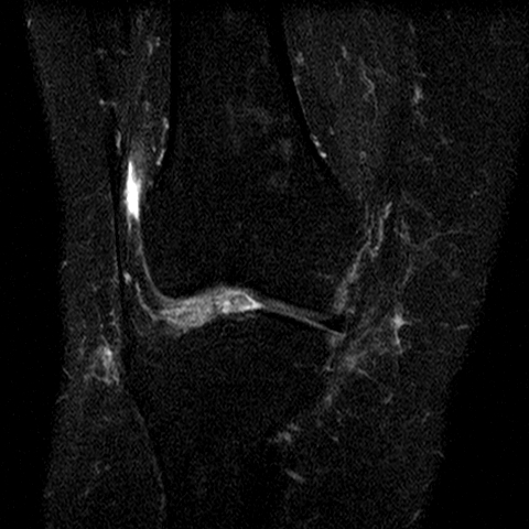 File:Anterior cruciate ligament mucoid degeneration (Radiopaedia 60853-68633 Coronal STIR 15).jpg