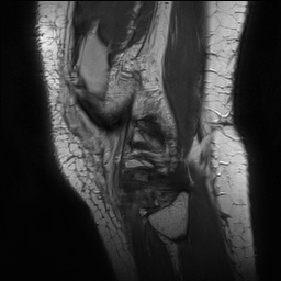 Anterior cruciate ligament rupture with Segond fracture (Radiopaedia 69043-78806 Sagittal PD 165).jpg