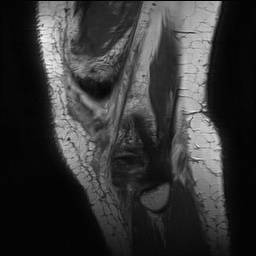 Anterior cruciate ligament rupture with Segond fracture (Radiopaedia 69043-78806 Sagittal PD 170).jpg