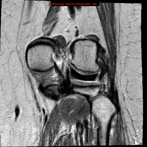 File:Anterior cruciate ligament tear (Radiopaedia 12329-12612 Coronal PD 18).jpg
