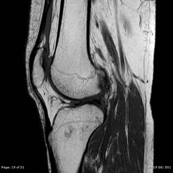 File:Anterior cruciate ligament tear (Radiopaedia 70783-80964 Sagittal T1 19).jpg