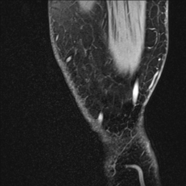 Anterior cruciate ligament tear - ramp lesion (Radiopaedia 71883-82322 Sagittal T1 vibe 142).jpg