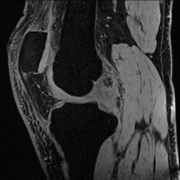 Anterior cruciate ligament tear - ramp lesion (Radiopaedia 71883-82322 Sagittal T1 vibe 82).jpg