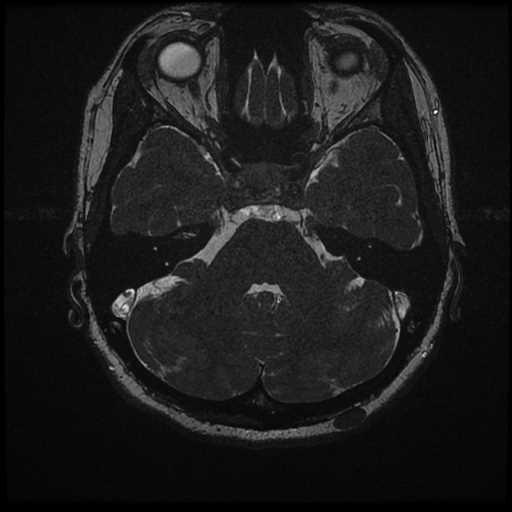 Anterior inferior cerebellar artery vascular loop - type II (Radiopaedia 70991-81209 Axial 3D FIESTA 25).jpg