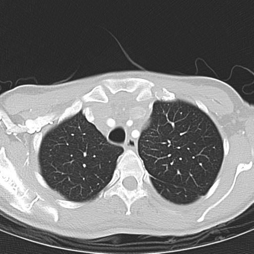 Anterior mediastinal lymphoma (Radiopaedia 29556-30061 Axial lung window 12).jpg
