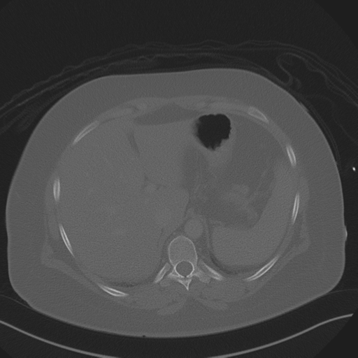 Anterior superior iliac spine avulsion fracture (Radiopaedia 44541-48244 Axial bone window 21).png