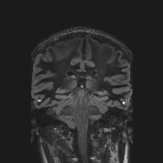 Anterior temporal encephalocele (Radiopaedia 82624-96808 Coronal FLAIR 32).jpg