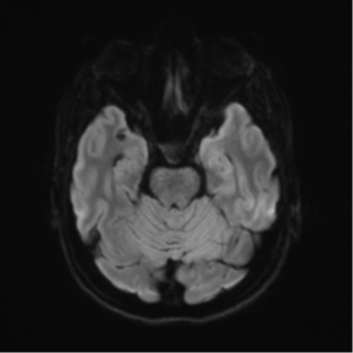 Anterior temporal lobe perivascular space (Radiopaedia 40946-43650 Axial DWI 36).png
