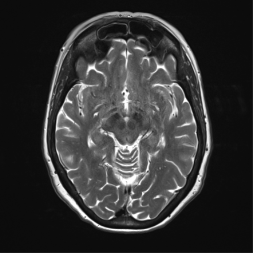 File:Anterior temporal pole cysts (Radiopaedia 46629-51102 C 17).png