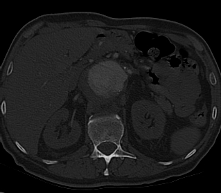 File:Anterior vertebral scalloping (abdominal aortic aneurysm) (Radiopaedia 66744-76067 Axial bone window 34).jpg