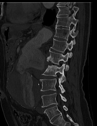 File:Anterior vertebral scalloping (abdominal aortic aneurysm) (Radiopaedia 66744-76067 Sagittal bone window 49).jpg