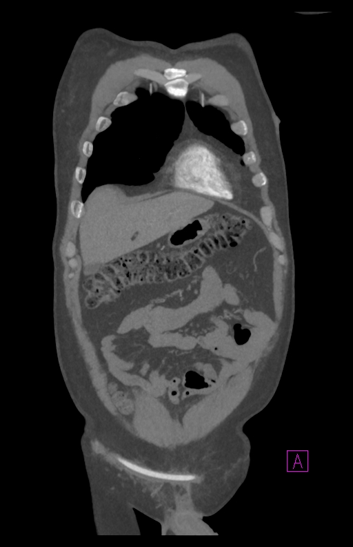 Aortectomy and axillary-bifemoral bypass (Radiopaedia 28303-28545 C 21).jpg