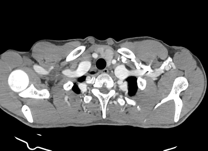 File:Aortic coarctation with aneurysm (Radiopaedia 74818-85828 A 176).jpg