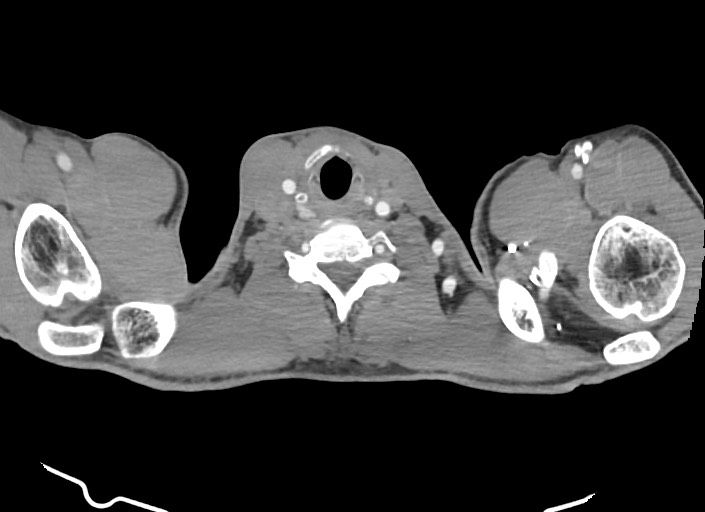File:Aortic coarctation with aneurysm (Radiopaedia 74818-85828 A 196).jpg