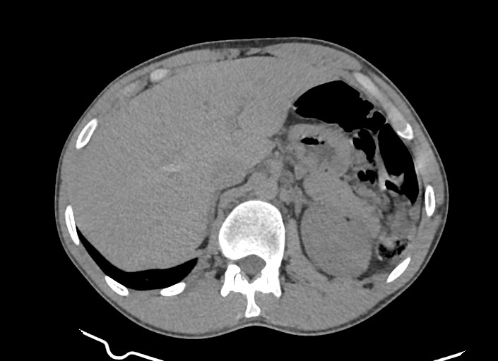 File:Aortic coarctation with aneurysm (Radiopaedia 74818-85828 A 27).jpg