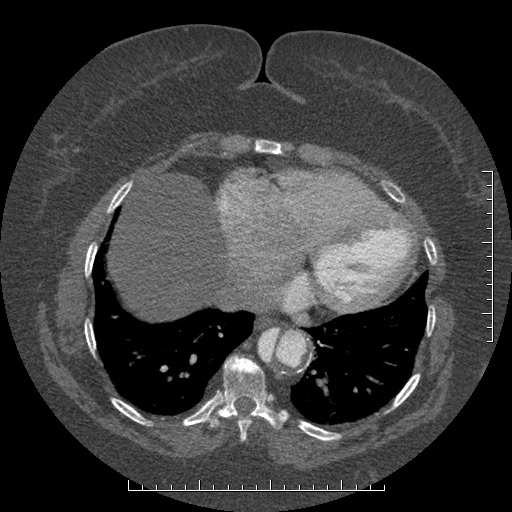 Aortic dissection- Stanford A (Radiopaedia 35729-37268 B 4).jpg