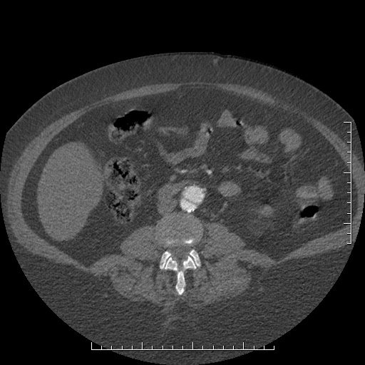 File:Aortic dissection- Stanford A (Radiopaedia 35729-37268 C 21).jpg