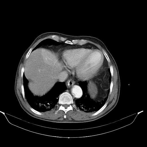 Aortic dissection- Stanford type A (Radiopaedia 22085-22085 A 32).jpg